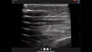 USM  Catheter Thrombi [upl. by Debbra905]