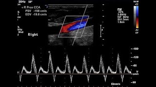 Color Doppler vs Power Doppler [upl. by Ammej]