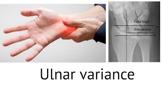 Ulnar variance negative and positive ulnar variance complicationstreatment [upl. by Ahsed]