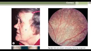 Kanski made easy  cornea 3 [upl. by Sylram]