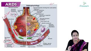 Acute Respiratory Distress Syndrome ARDS Part 1  Internal medicine 🫁🫁🫁 [upl. by Lehsreh836]