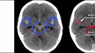 Subarachnoid haemorrhage  Pathology cases  USMLE Step 1 [upl. by Garrot]