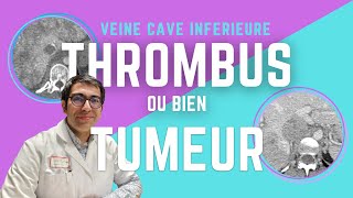 Thrombus ou Tumeur  La VEINE CAVE INFERIEURE en deux scanners démonstratifs [upl. by Neehcas976]