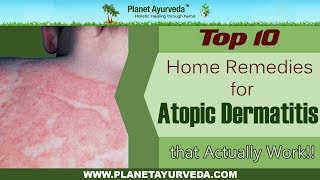 Top 10 Home Remedies For Atopic Dermatitis Eczema That Actually Work [upl. by Ldnek]