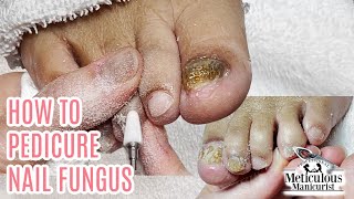 How to do a Pedicure on a Bad Case of Nail Fungus transformation [upl. by Oedama433]