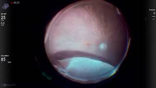 Pseudophakic retinal detachment in vitrectomized eye Vista Live Stream [upl. by Frayne789]