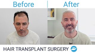 Hair Transplant Results  Testimonial Review  FUE 2718 Grafts  Before and After  Karl [upl. by Gio]