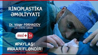 Rinoplastika Burun plastik emeliyyati tam izle  Dr Vuqar Ferhadov LOR Estetik Cerrah MEDPLUS [upl. by Elurd365]