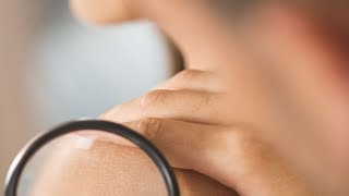 Les dermatologues dénoncent la chirurgie esthétique des grains de beauté [upl. by Oidiple969]