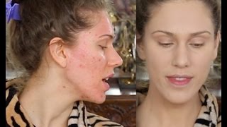 Acne Scar Foundation Routine  Full Coverage Flawless Makeup Tutorial  Pores amp Ice Pick Scarring [upl. by Oidgime]