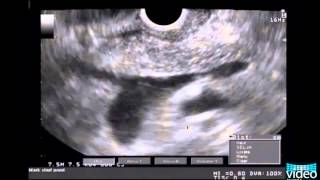 Diagnosis of Pancreas Divisum Using LinearArray Endosonography [upl. by Adaha]