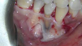 Treatment of Radicular Cyst Using PRF and Bone Graft after Enucleation by Dr Ammar Hobbi [upl. by Harias]