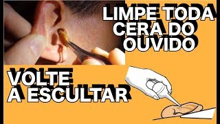 LIMPE TODA CERA DO OUVIDO E VOLTE A ESCUTAR FACIL E RAPIDO [upl. by Htabmas]