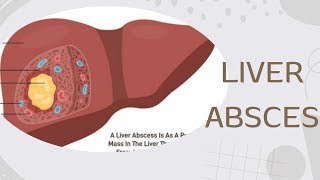 TOPICquot30LIVER ABSCESSamp ITS CAUSES SIGN SYMPTOMS DIAGNOSIS AND TREATMENT [upl. by Maurreen794]