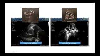 2AM L’Échocardiographie Doppler dans la tétralogie de Fallot S EL KARIMI [upl. by Clint]