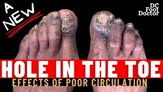 A New Hole In The Toe Fungal Toenails Calluses and Underlying Ulcers [upl. by Hayyikaz]