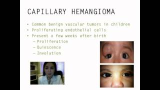 Periocular capillary hemangioma management  Video abstract 39029 [upl. by Sussman428]