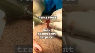 After hair transplant surgery Hair removal haircareshortviralvideoexplorepage [upl. by Rafaelle]