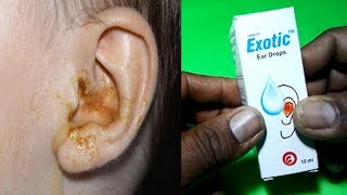 Exotic Ear Drop Review Uses And Side Effects [upl. by Dimah]