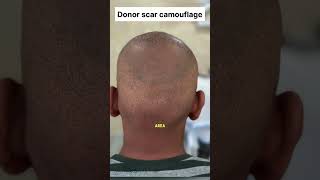 Scalp micropigmentation after hair transplant failureDonor scar camouflage scalpmicropigmentation [upl. by Atnovart]