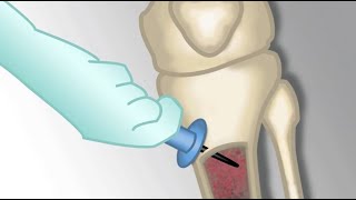 quotPlacement of an Intraosseous Linequot by Monica Kleinman MD for OPENPediatrics [upl. by Cogswell765]