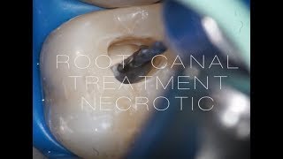 ROOT CANAL TREATMENT 16 necrotic case [upl. by Kimitri]