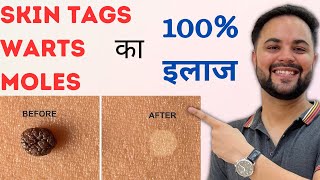 Skin Tags Warts amp Moles का 100 इलाज with Home Remedies [upl. by Aniloj283]