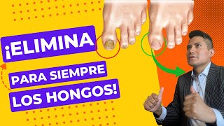 HONGOS EN LAS UÑAS✅ COMO PREVENIR CURAR Y ELIMINAR PARA SIEMPRE [upl. by Clarisa]