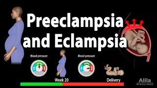 Preeclampsia and Eclampsia Animation [upl. by Lemuelah]