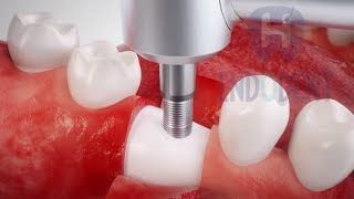 Colocación de implantes dentales paso a paso vídeo animado [upl. by Shaefer625]