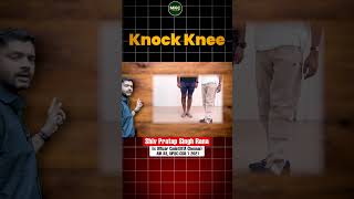 Knock Knee Problem in Army Medical 😲 Knock Knee Problem Solution  Knock Knee kaise thik kare [upl. by Colbye]