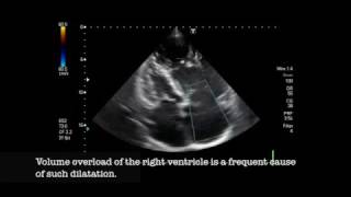 Severe pulmonic regurgitation [upl. by Odine]