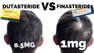 Dutasteride Mega Guide  Better Than Finasteride [upl. by Dnomso]