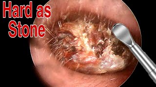 BIGGEST Ear Wax Difficult Removal  EP2  Doctor Anh [upl. by Lorusso]