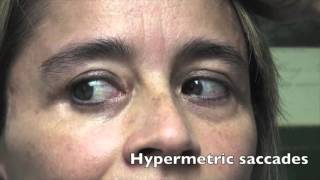 Case Challenge The patient had hypermetric saccades Video 1 [upl. by Airretnahs]