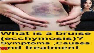 What is a bruise ecchymosis Symptoms  Causes and treatment [upl. by Sands]