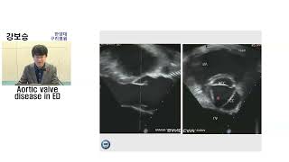 ER과 대동맥 판막 Aortic valve disease in ER  강보승 한양의대 [upl. by Abeh]