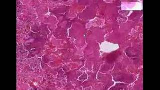 Histopathology LungAspiration pneumonia infant [upl. by Yesrod379]