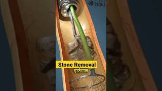 Kidney stone treatment  Renal stones  RIRS  Retrograde intrarenal surgery  shorts [upl. by Amron]