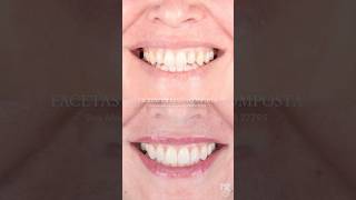 ORTODONTIA E ESTÉTICA DENTAL dentista invisalign facetas [upl. by Lek]