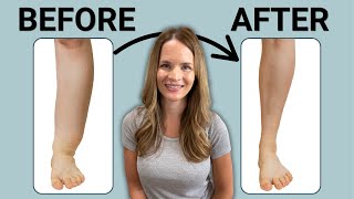 The Best Leg Lymphedema Treatment [upl. by Yahsal]