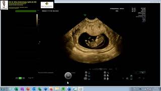 TRISOMI 21  NUCHAL EDEMA TEBAL  HYDROPS FETALIS 12 WEEKS Dr Wiku Andonotopo [upl. by Lamp]