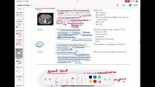 pheochromocytoma endocrinology 80  First Aid USMLE Step 1 in UrduHindi [upl. by Ellora]