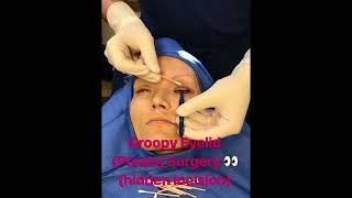 Droopy Upper Eyelids Ptosis Surgery [upl. by Kieger]