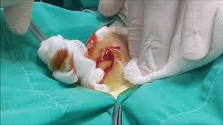 Apse Kasıkta  Abscess İnguinal region [upl. by Brinn]