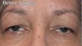 Oculoplastic Surgery Eyelid surgery Dr Jennifer Hui Palm Springs  Palm Desert CA [upl. by Slack]