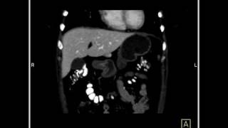 Abdomen Liver Focal Nodular Hyperplasia CT Angiography6 of 6 [upl. by Cicely]