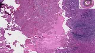 Histopathology Acute Appendicitis [upl. by Inej809]