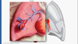 IVC Filters [upl. by Rama]