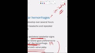 Intracerebral Hemorrhage  Part 3 [upl. by Aneres25]